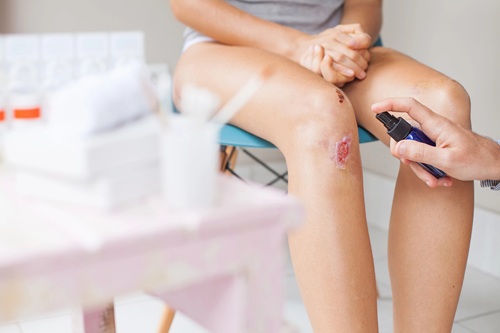 Hypochlorous Acid for Wound Healing: A Natural Aid in Healthcare
